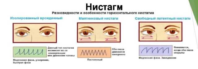 Нистагм: причины, виды и лечение профилактика