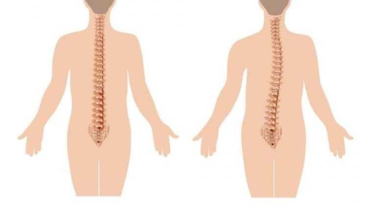 Искривление позвоночника: классификация, причины и последствия