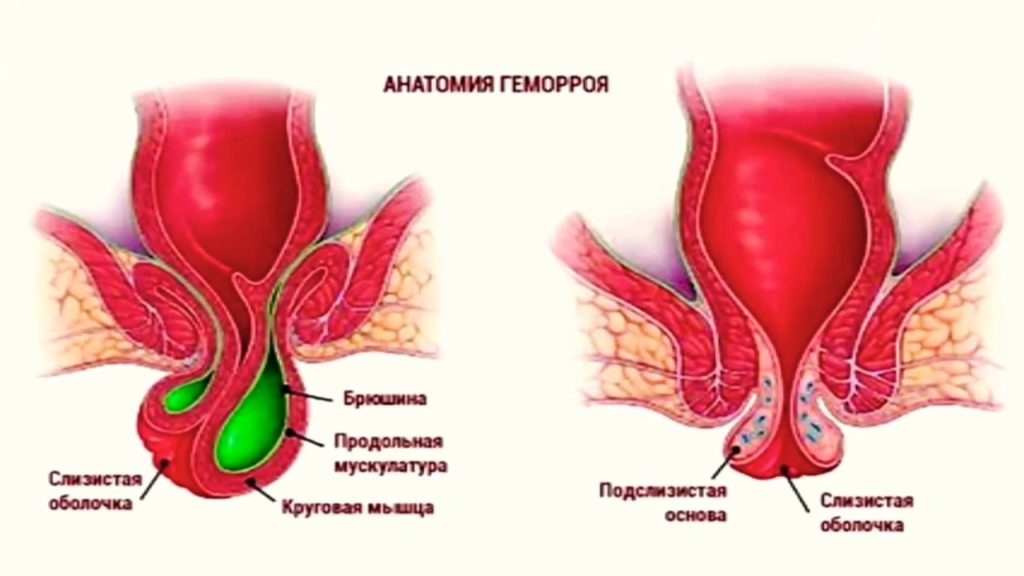 как выглядит наружный геморрой