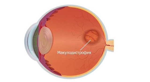 Макулодистрофия: виды, причины, диагностика и лечение