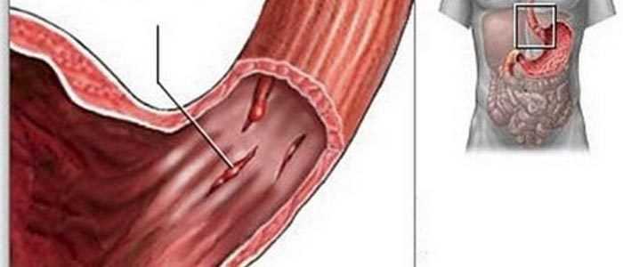 Синдром бурхаве или спонтанный разрыв пищевода