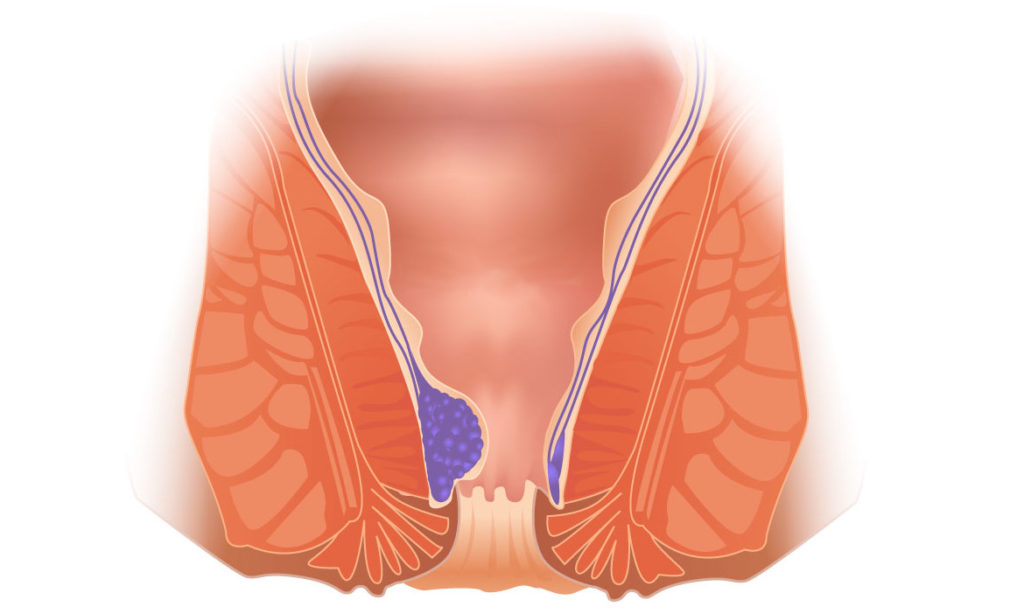 внутренний геморрой