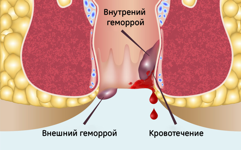 Первые симптомы и признаки стадии внешнего внутреннего геморроя